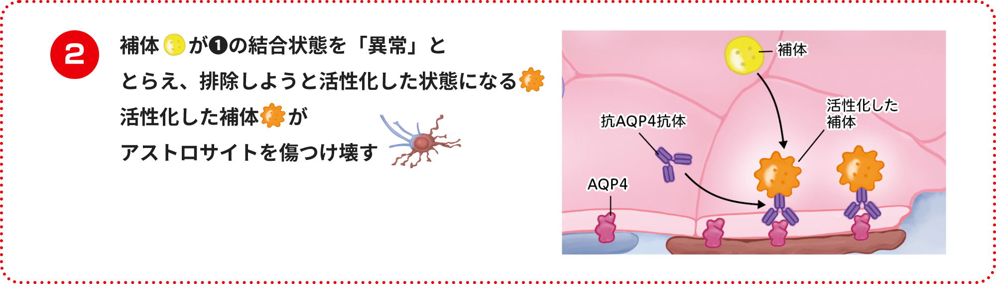 補体が❶の結合状態を「異常」ととらえ、排除しようと活性化した状態になる活性化した補体がアストロサイトを傷つけ壊す