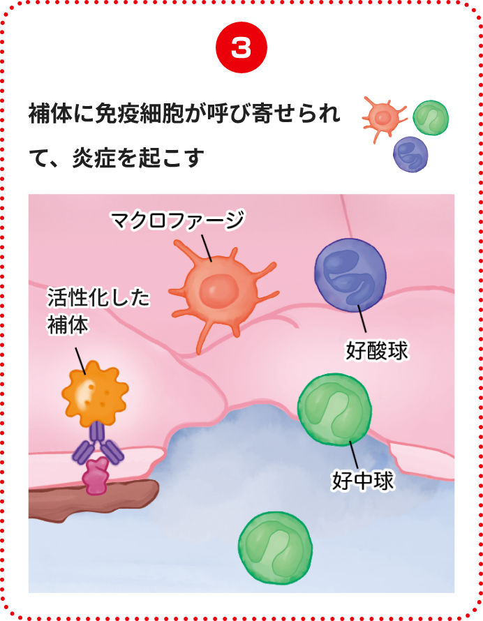 補体に免疫細胞が呼び寄せられて、炎症を起こす