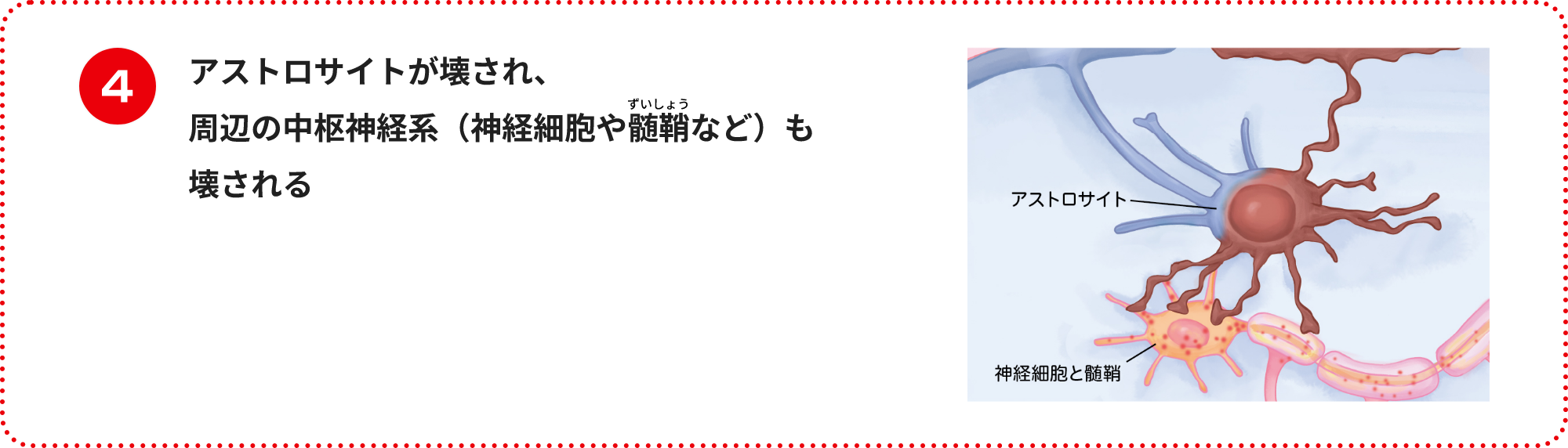 アストロサイトが壊され、周辺の中枢神経系（神経細胞や髄鞘など）も壊される